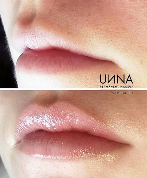 hyaluronic-pen-cristina-ilie hyaluronic-pen-cristina-ilie