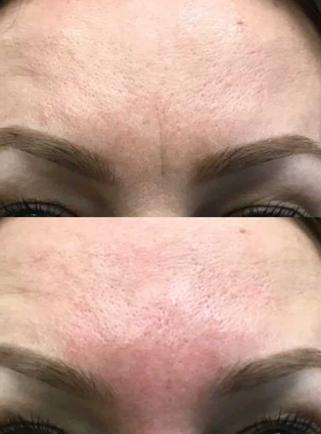 2-hyaluronic-pen-unna-studio 2-hyaluronic-pen-unna-studio