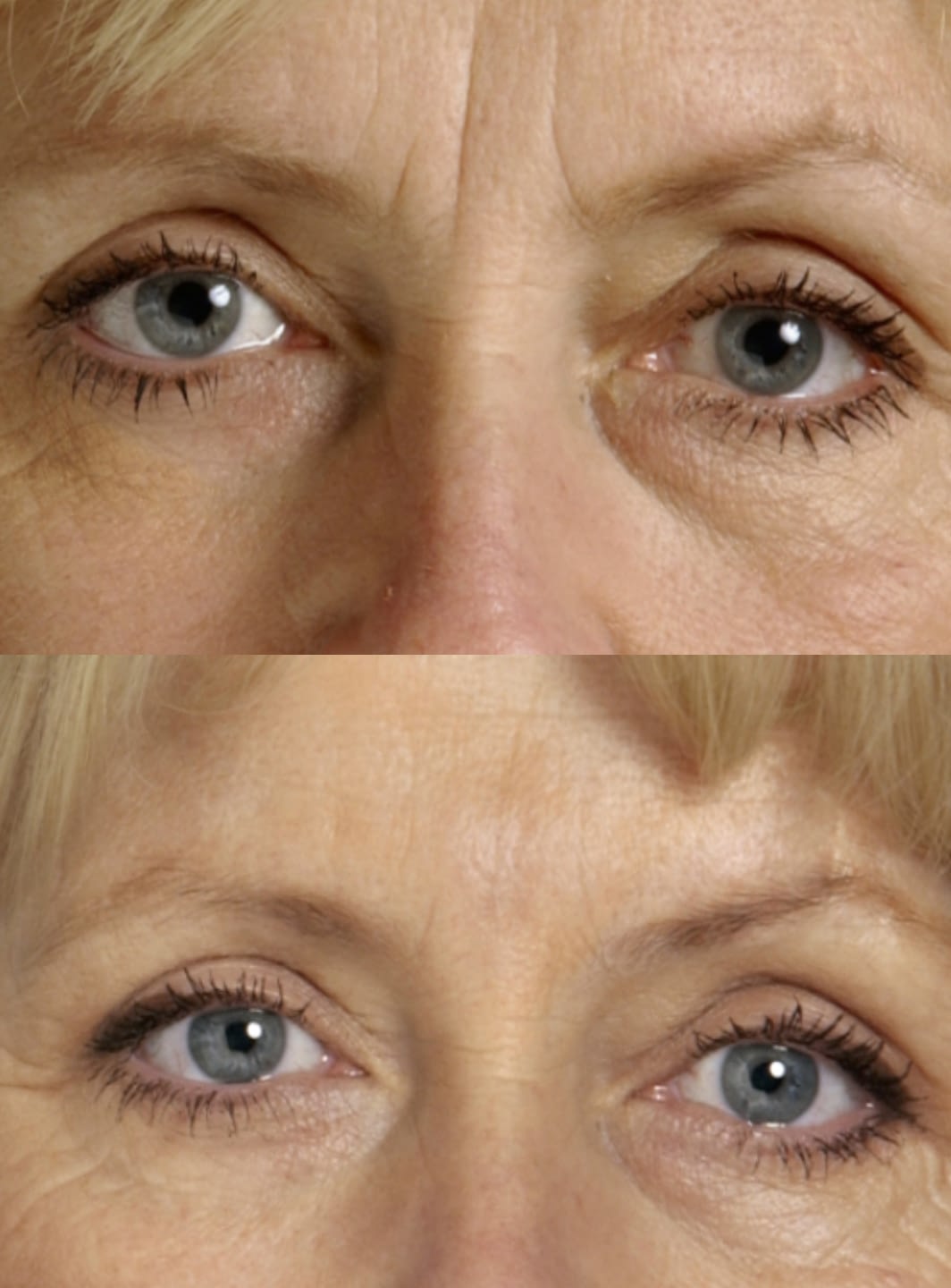 5-hyaluronic-pen-unna-studio 5-hyaluronic-pen-unna-studio