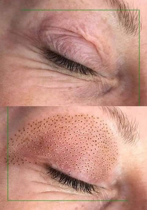 plasma-pen-tratament-bucuresti-min Plasma pen fibroblast pleoape